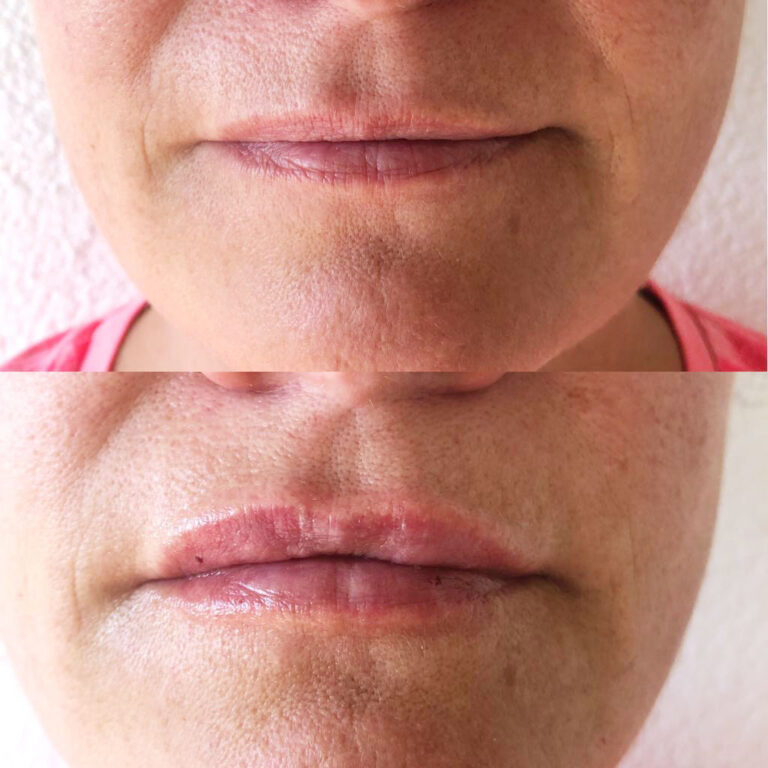 Lippenfilling Naturheilpraxis Andrea Bous